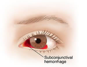 Subconjunctival-Hemorrhage